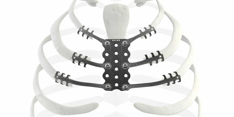NFI crée un implant en titane pour le sternum