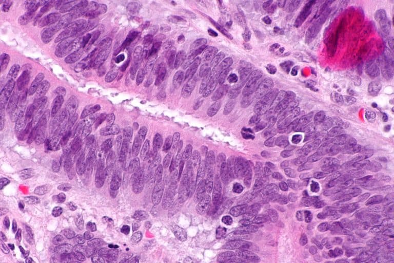 Des nanorobots s&rsquo;attaquent aux cancers