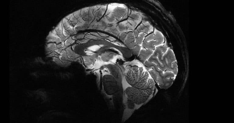 Cette IRM révolutionnaire dévoile le cerveau humain comme jamais auparavant, repoussant les limites de la science