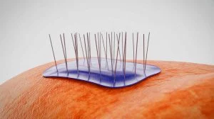 Illustration de nanoneedles sur un patch médical révolutionnaire. Image réalisée par IA.